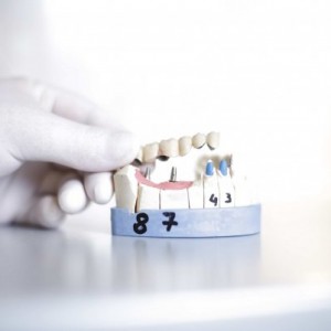 most kombinowany na implantach i na zębach