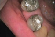 Zęby nr 24 i 25 ze starymi plombami metalowymi