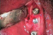 wkręcone śruby implantowe - zdjęcie wykonane podczas zabiegu chirurgicznego
