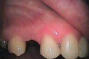 protetyka 2 1 180x120 - Niekonwencjonalne rozwiązanie w przypadku braku zęba