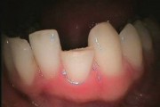 złamanie zęba 32